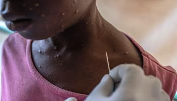 A boy receives treatment for mpox, Munigi, DRC, August 19, 2024 (Moise Kasereka/EPA-EFE/Shutterstock)